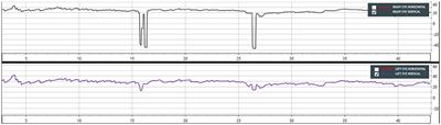 Clinical and VNG Features in Anterior Canal BPPV—An Analysis of 13 Cases